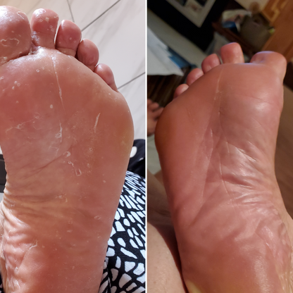 HeDerm Antifungal Soap