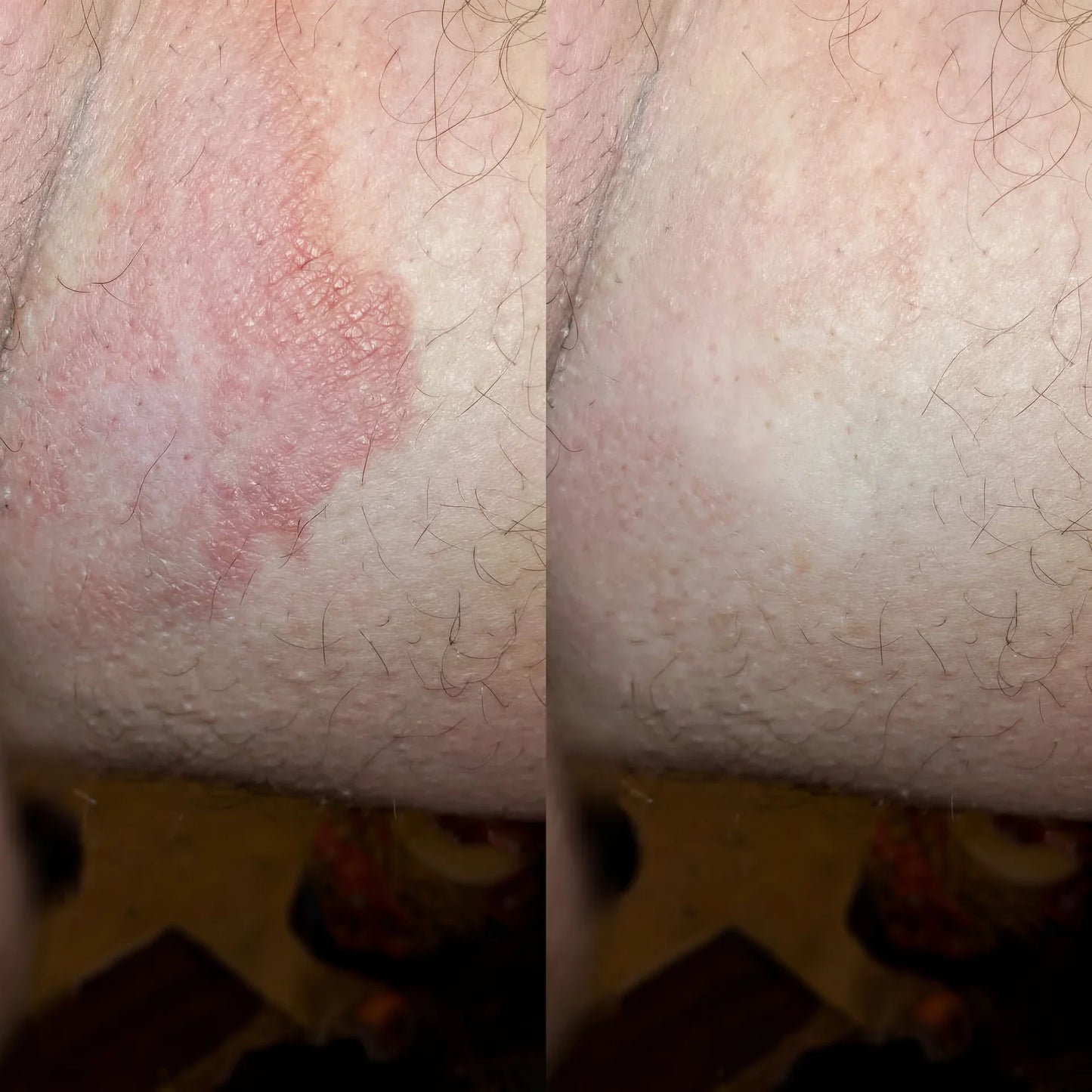 HeDerm Antifungal Soap