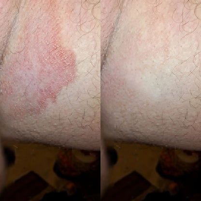 HeDerm Antifungal Soap